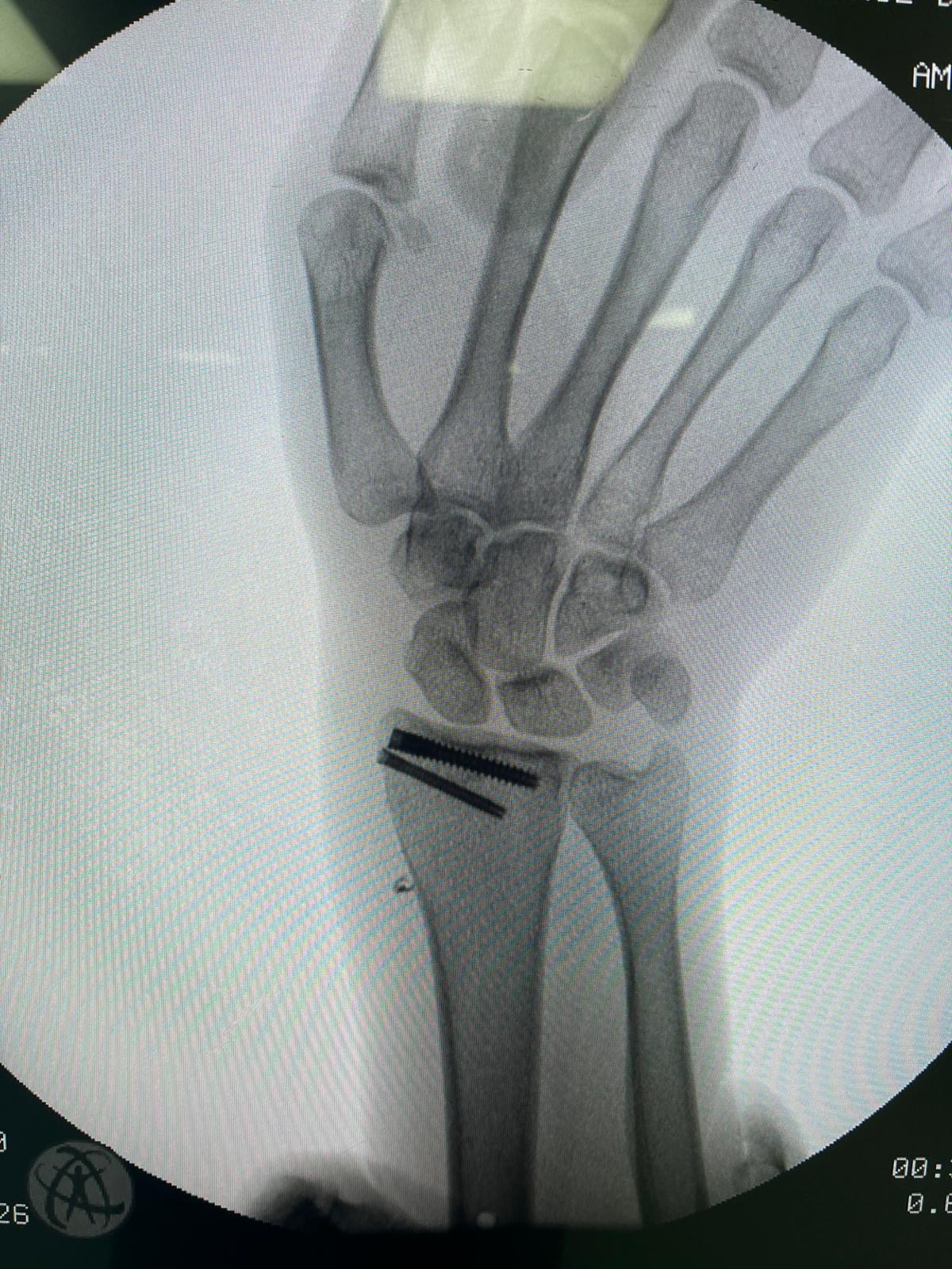 Distal Radius Kırığında Vida Tespiti Ameliyatı