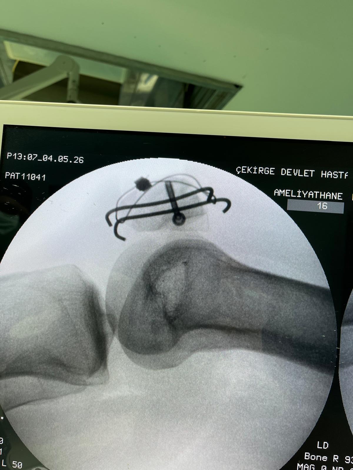 Patella (Diz Kapağı) Kırığında Cerrahi Tespit Ameliyatı